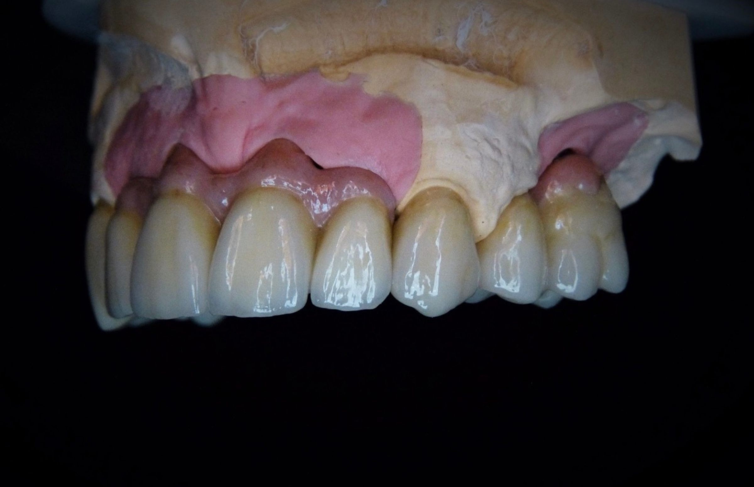 Dental-circus - Branemark , Branemarkuv most, all on 4, All on 5, All on 6, All on X, Hybridní náhrady, třmen na implantátech, zubní laboratoř, zubní technik,