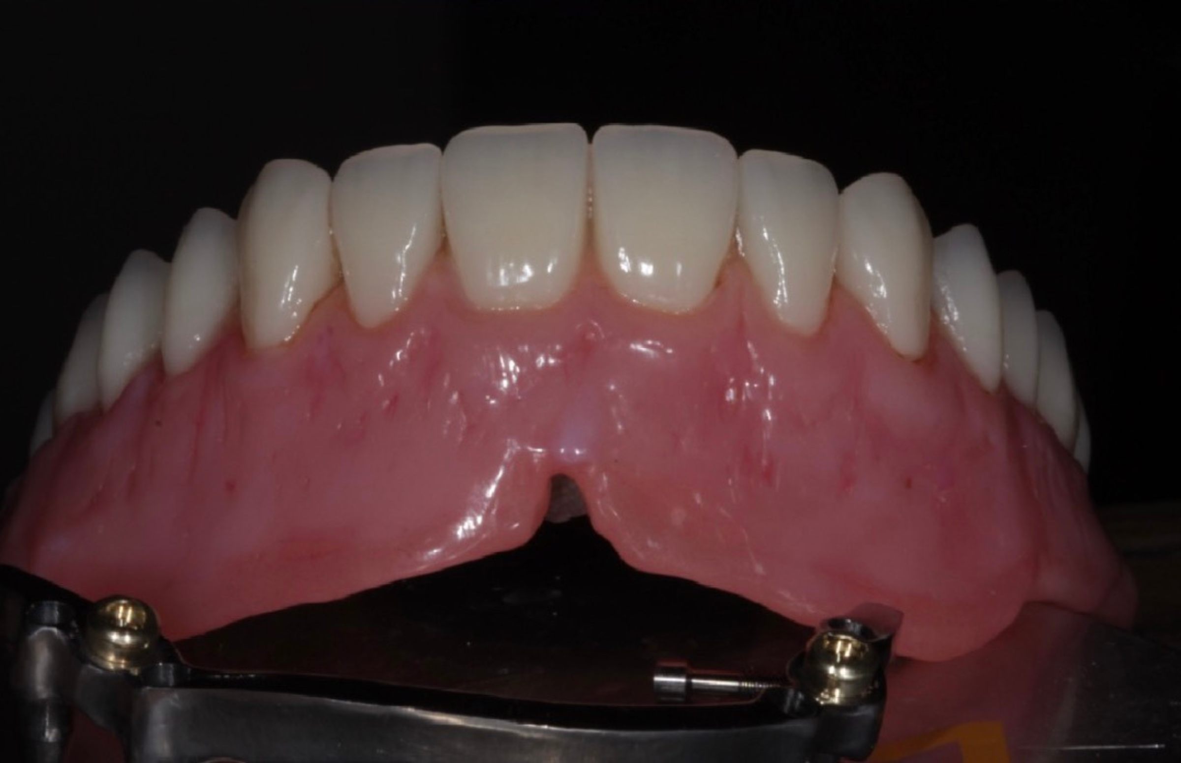 Dental-circus - Branemark , Branemarkuv most, all on 4, All on 5, All on 6, All on X, Hybridní náhrady, třmen na implantátech, zubní laboratoř, zubní technik,