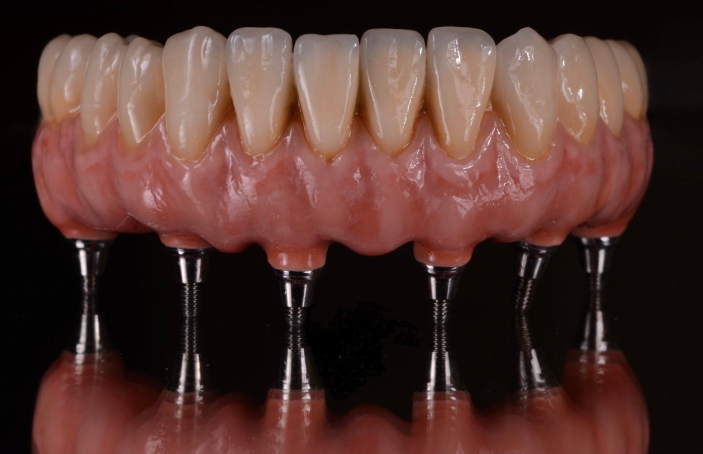 Dental-circus - Branemark , Branemarkuv most, all on 4, All on 5, All on 6, All on X, Hybridní náhrady, třmen na implantátech, zubní laboratoř, zubní technik,