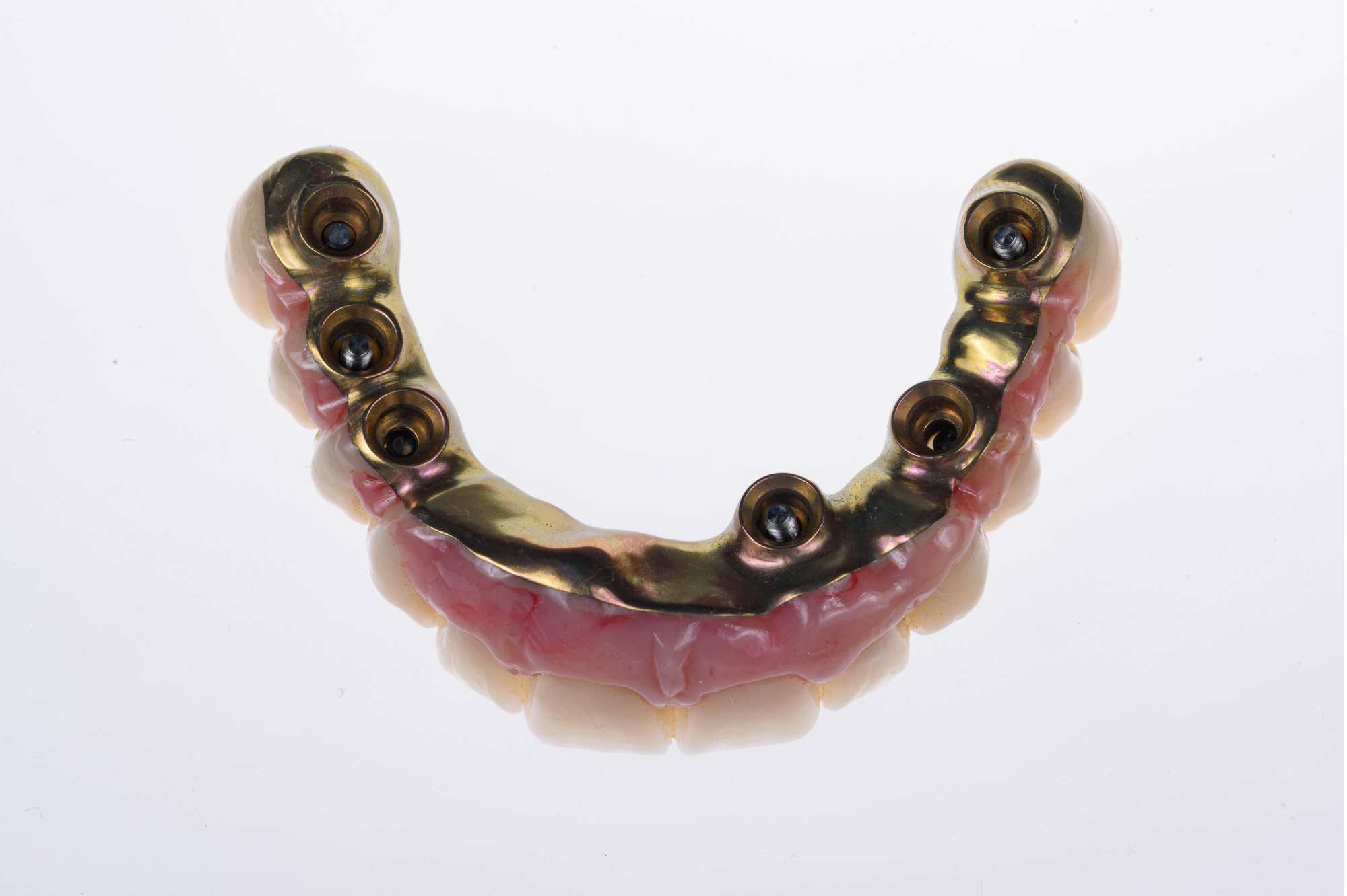 Dental-circus - Branemark , Branemarkuv most, all on 4, All on 5, All on 6, All on X, Hybridní náhrady, třmen na implantátech, zubní laboratoř, zubní technik,