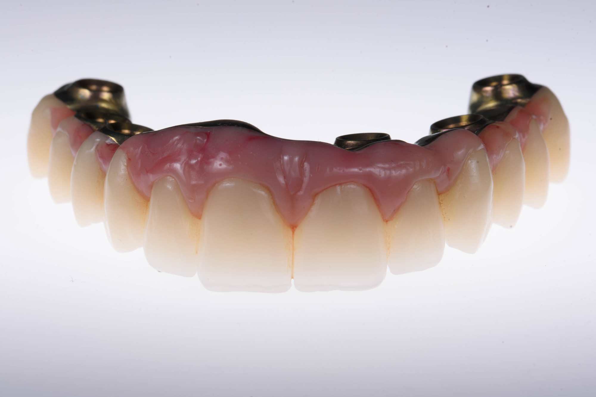 Dental-circus - Branemark , Branemarkuv most, all on 4, All on 5, All on 6, All on X, Hybridní náhrady, třmen na implantátech, zubní laboratoř, zubní technik,