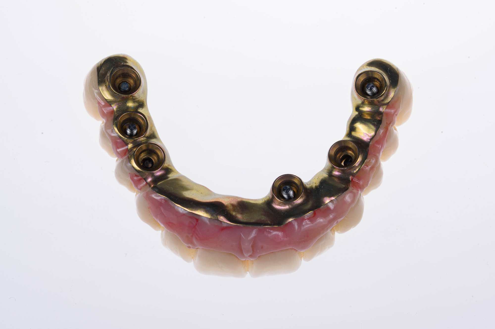 Dental-circus - Branemark , Branemarkuv most, all on 4, All on 5, All on 6, All on X, Hybridní náhrady, třmen na implantátech, zubní laboratoř, zubní technik,