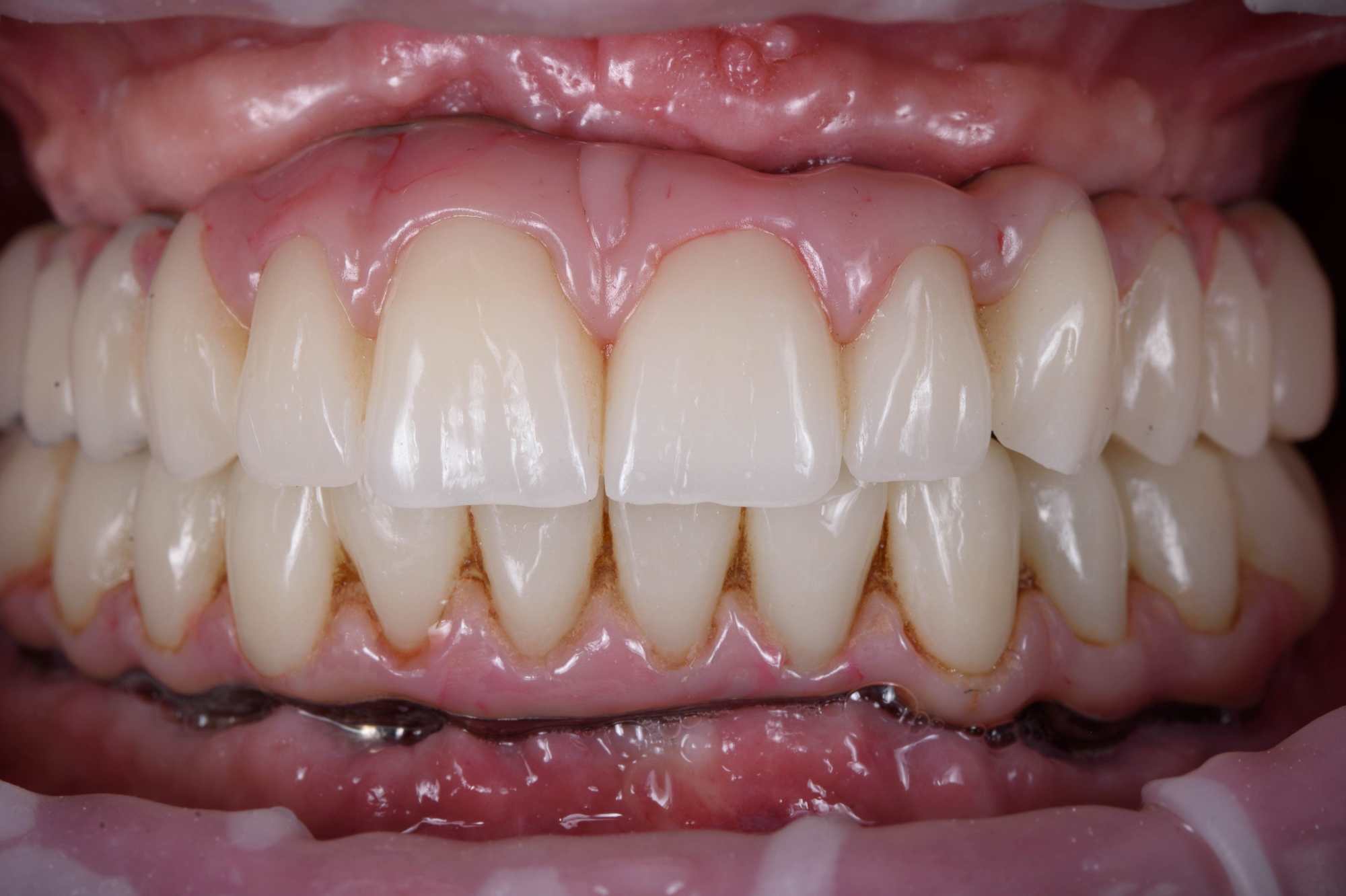 Dental-circus - Branemark , Branemarkuv most, all on 4, All on 5, All on 6, All on X, Hybridní náhrady, třmen na implantátech, zubní laboratoř, zubní technik,