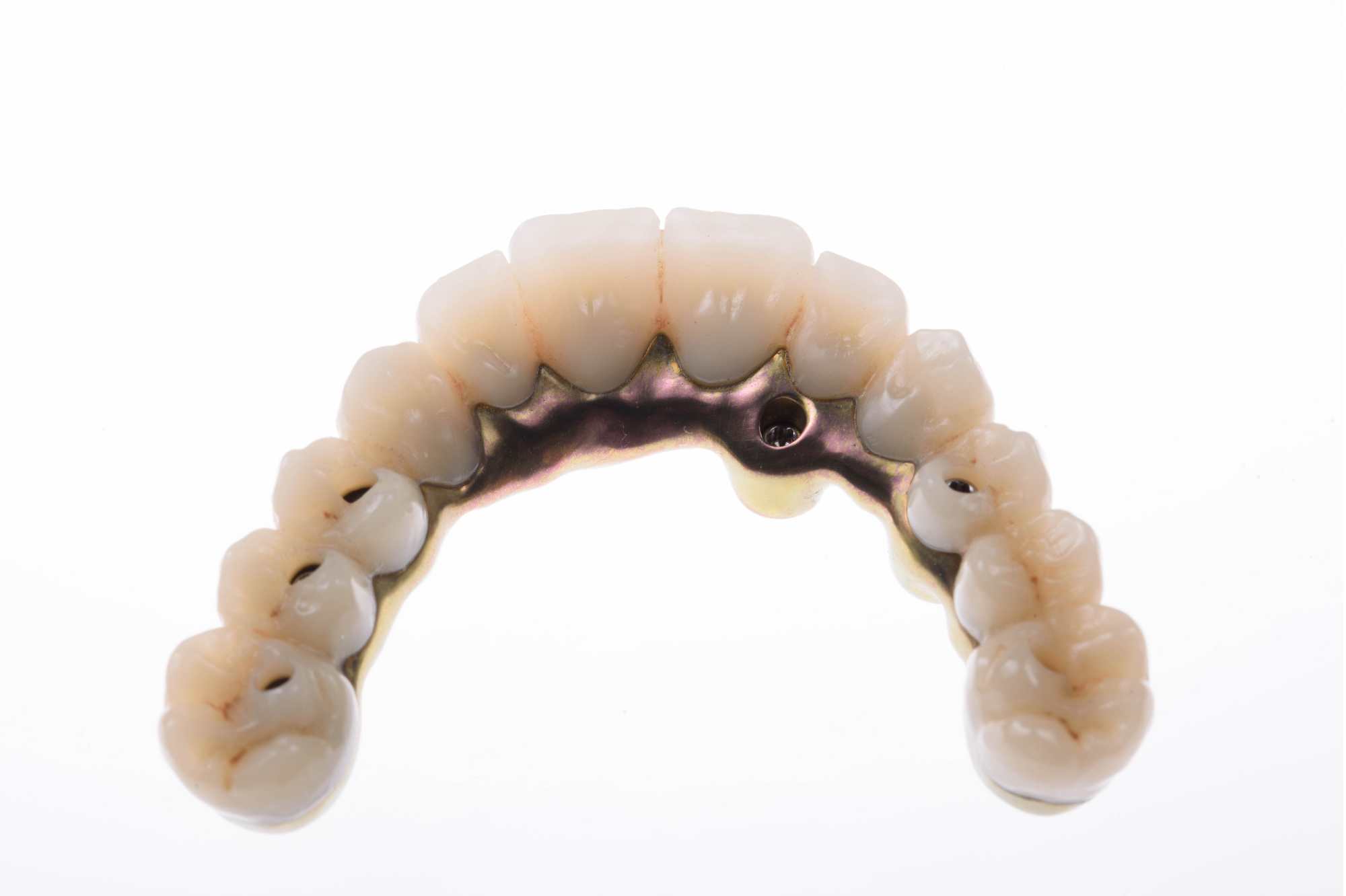 Dental-circus - Branemark , Branemarkuv most, all on 4, All on 5, All on 6, All on X, Hybridní náhrady, třmen na implantátech, zubní laboratoř, zubní technik,