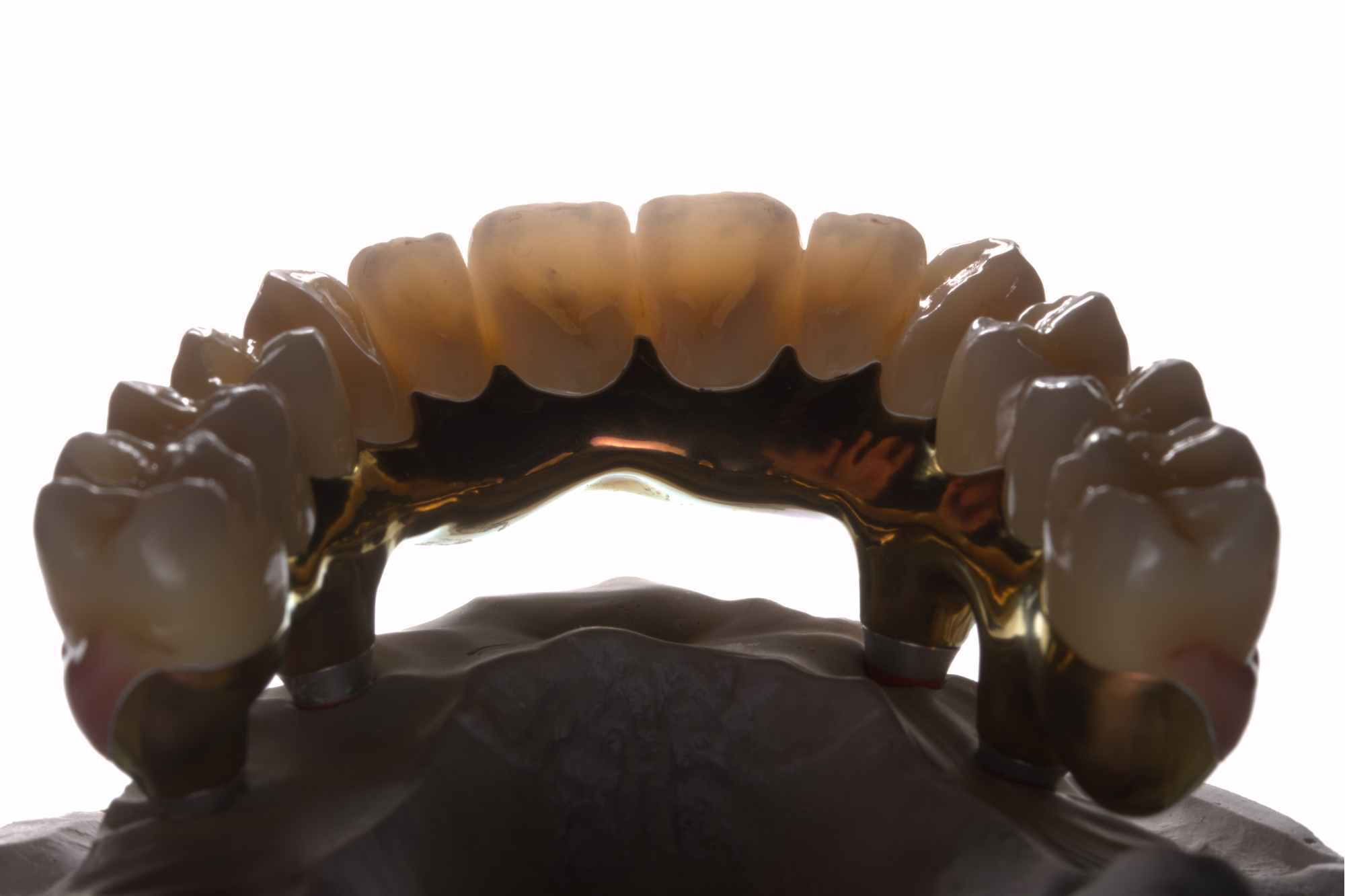 Dental-circus - Branemark , Branemarkuv most, all on 4, All on 5, All on 6, All on X, Hybridní náhrady, třmen na implantátech, zubní laboratoř, zubní technik,